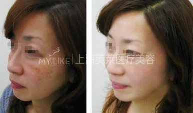 【关于美白的谣言】美白不是打是输液的…惊!!