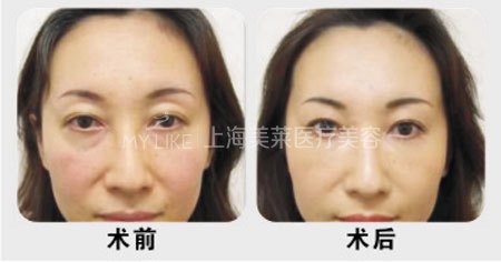 想要永葆青春,显老的眼袋必须割