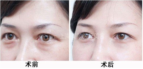 想要永葆青春,显老的眼袋必须割